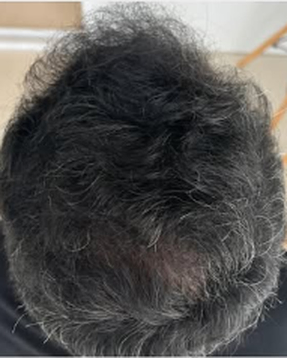 Comparação antes e depois de acompanhamento capilar